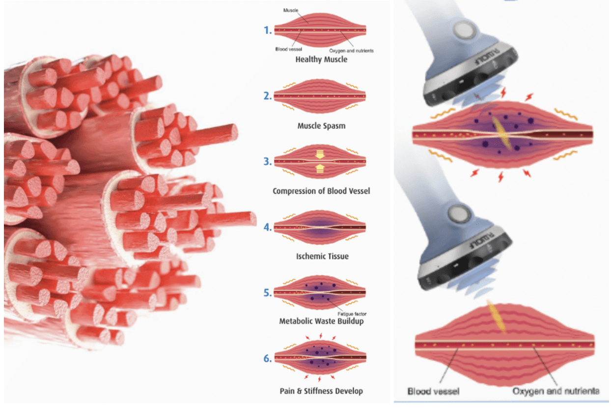 Shockwave therapy muscle type treatment areas